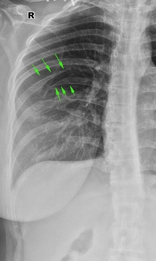Сращение ребер рентген. Перелом ребра снимок рентген. Неконсолидированный перелом ребра.