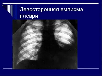 Гнойный плеврит