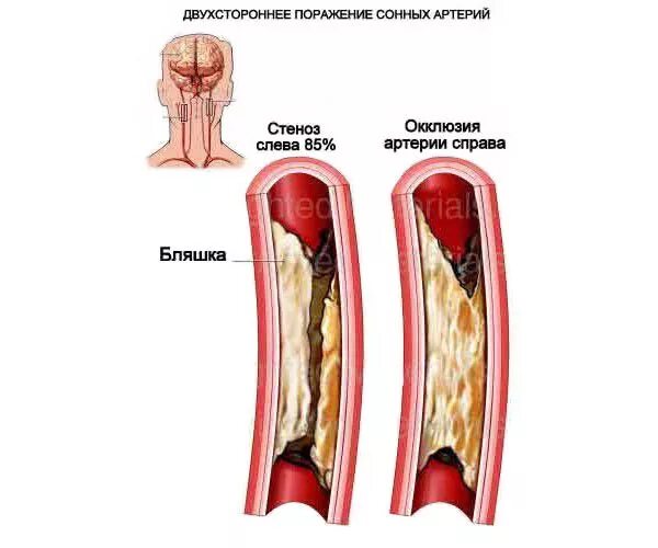 Атеросклеротические атеросклеротические поражения конечностей. Атеросклероз бляшка сонной артерии. Мультифокальное поражение атеросклерозе сосудов. Атеросклероз (закупорка кровеносных сосудов). Атеросклероз сосудов сонных артерий.