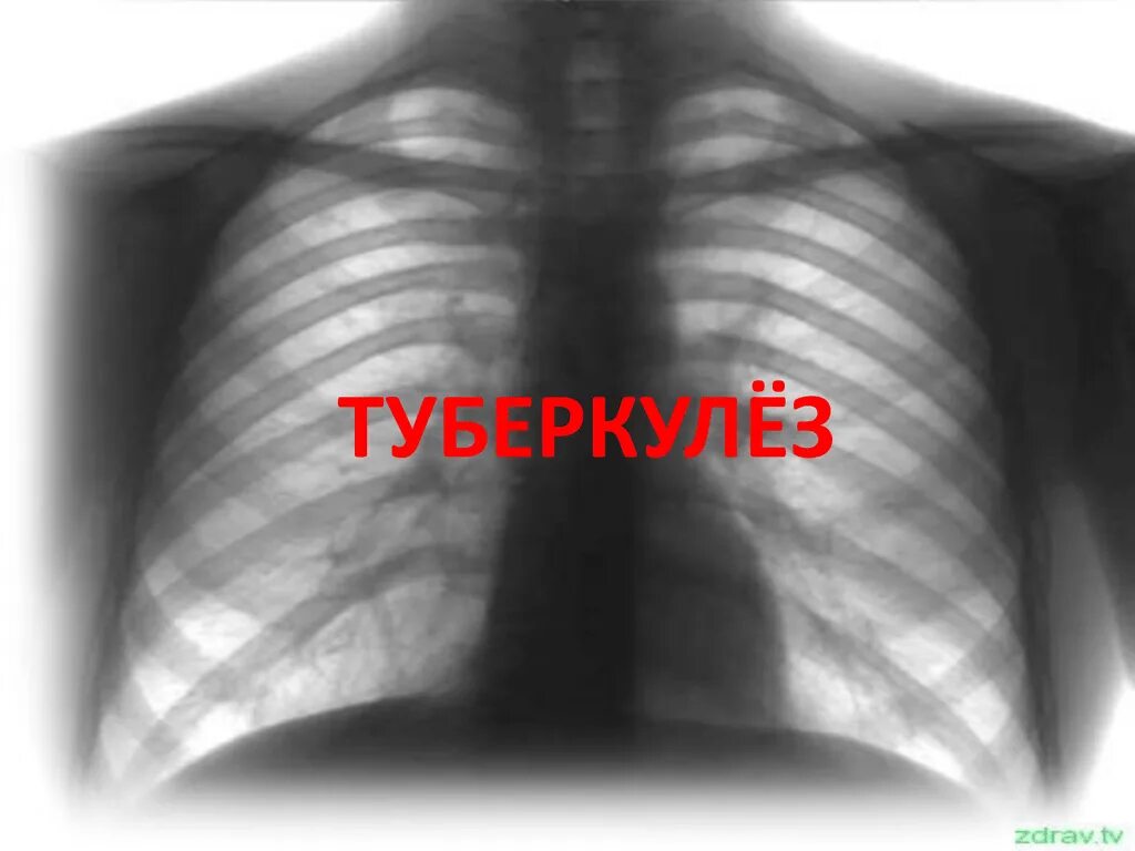 Без видимых патологий. Туберкулёз флюрография. Туберкулёз лёгких флюрография. Снимки легких. Легкие уурильщика нафлюрографии.