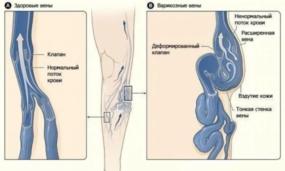 Вены ног клапаны. Варикозное расширение вен. Варикознаетрасширение вен. Клапаны вен нижних конечностей.