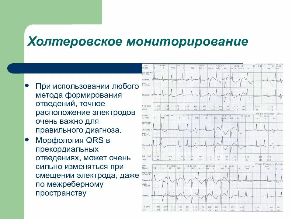 Холтер отведения. Отведения для холтер экг. отведения при холтеровском мониторировании. холтеровское мониторирование цель исследования. суточное мониторирование экг расположение электродов.