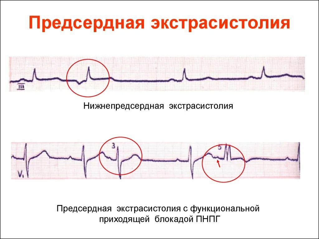 Предсердные экстрасистолы на ЭКГ. Предсердная экстрасистолия на ЭКГ. Экстрасистола предсердия на ЭКГ. Предсердная экстрасистолия на ЭКГ экстрасистол. Экстрасистолы врачам