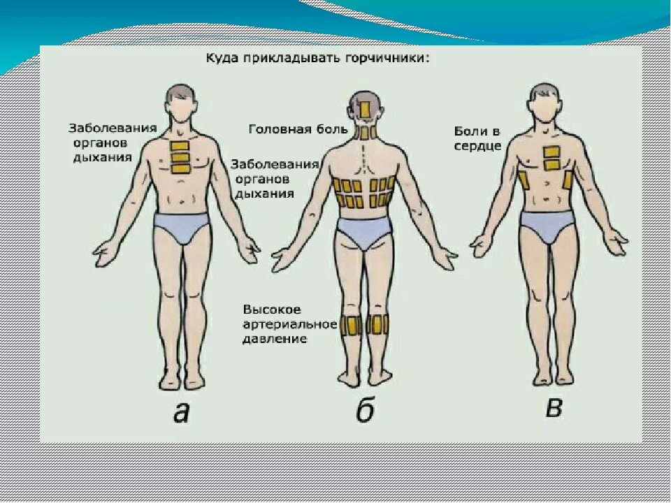 Можно ли ставить горчичники при кашле взрослому. Как правильно ставить горчичники при кашле. Места постановки горчичников при кашле. Зона наложения горчичников.