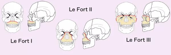 Le fort. Лефор переломы верхней челюсти. Перелом верхней челюсти Лефор 3.