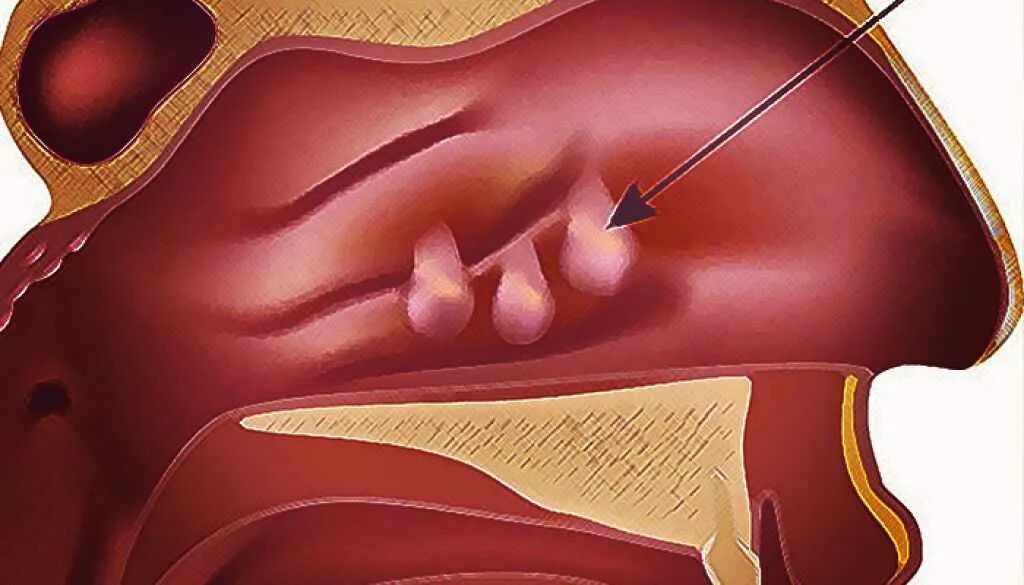 Полипозный риносинусит. Полипозный пансинусит что это такое. Полипозный риносинусит операция. Полипозный аллергический ринит. Слизистая оболочка уха