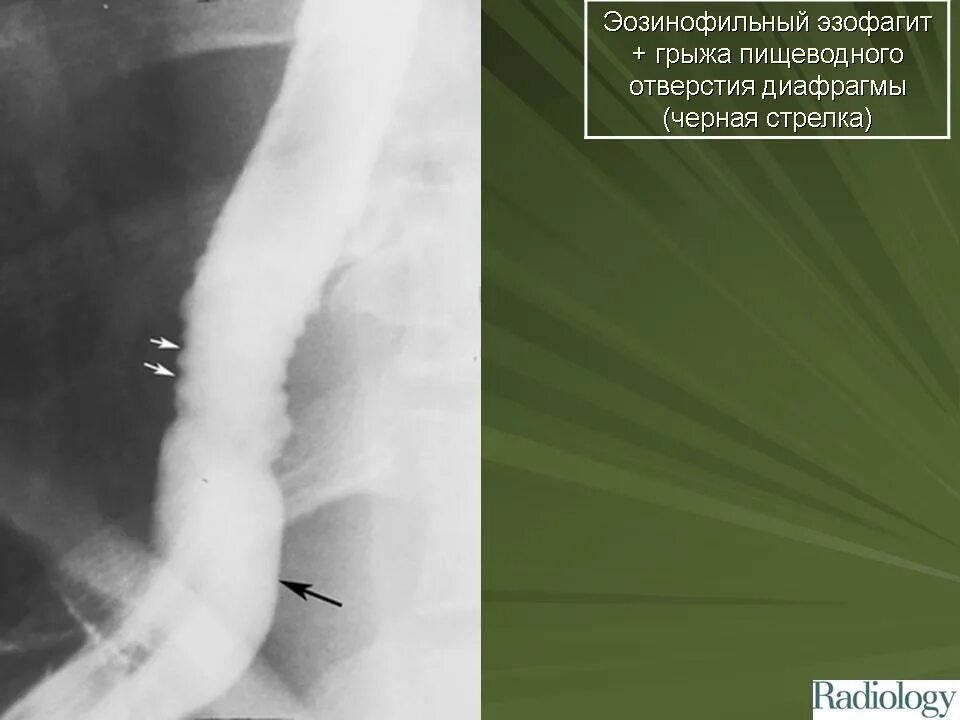 Грыжа диафрагмального отверстия пищевода. Грыжа пищеводного отверстия диафрагмы рентген. Грыжа пищеводного отверстия диафрагмы справа. Скользящие грыжи пищеводного отверстия диафрагмы рентген.