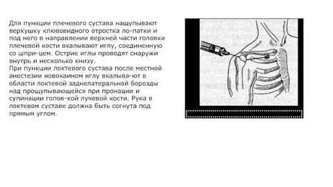 Пункция плечевого сустава