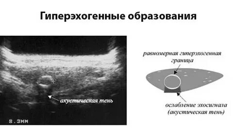 Гипоэхогенное образование с четкими контурами аваскулярное