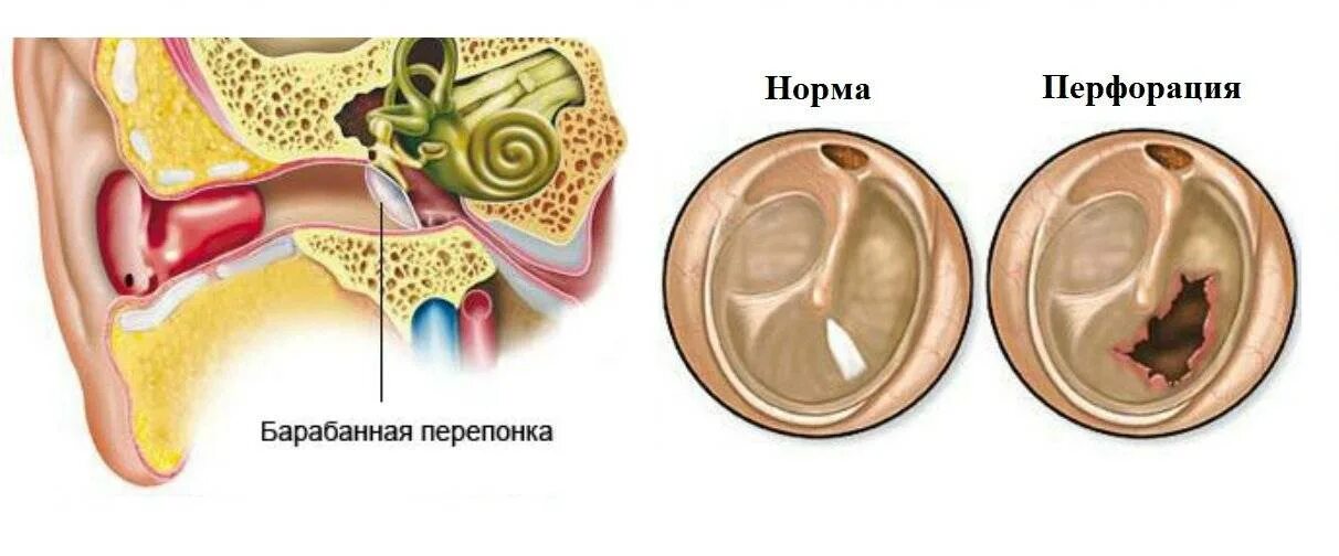 Гнойный отит с перфорацией. Экссудация барабанной перепонки.