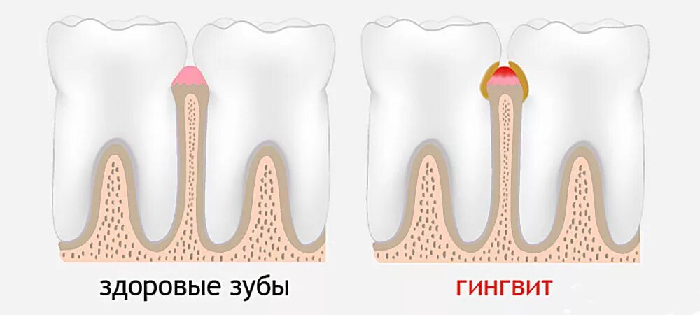 Курить после лечения зуба. Некротический гингивит Венсана. Язвенно некротический гингивит. Язвенно-некротический гингивит-пародонтит. Гингивит стоматология.