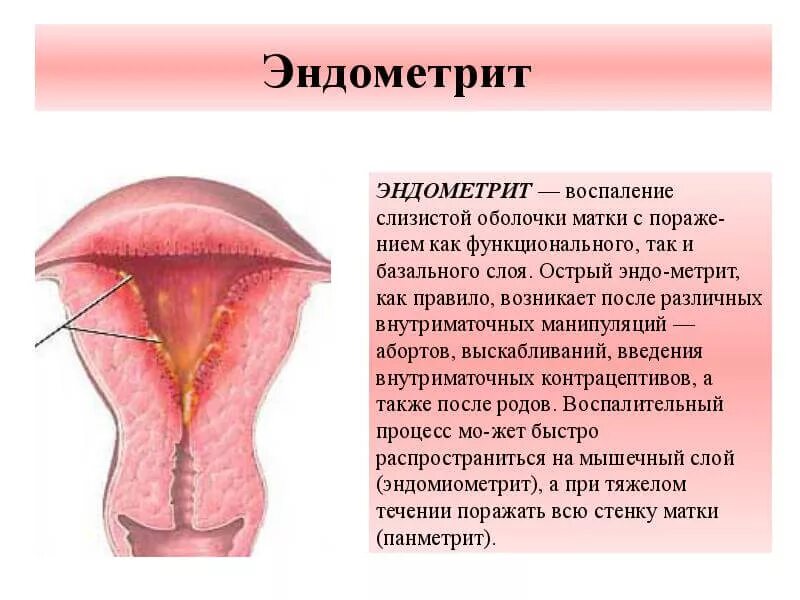 Воспаление слизистой оболочки матки. Хронический эндометрит. Хронический эндометрий. Причина эндометрии у женщин