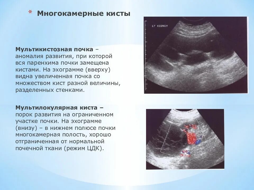 Парапельвикальная киста почки. Кисты почек лучевые симптомы. V образование в левой почке. Эхопризнаки кисты почек. Паренхиматозная киста почки.