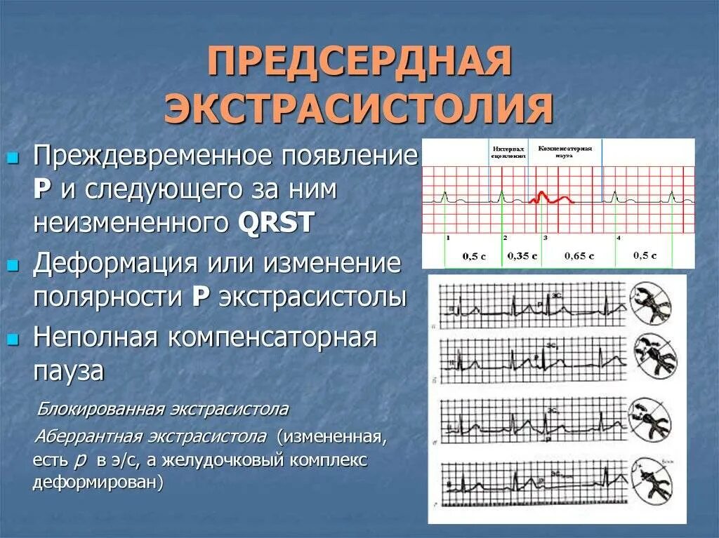 эктопический предсердный ритм на экг. эктопический нижнепредсердный ритм на экг. эктопический ритм сердца на экг. эктопический нижнепредсердный ритм на экг. эктопический ритм сердца на экг.