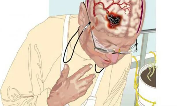 Поражение мозга последствия. Микроинсульт лобной доли. Кровоизлияние в головной мозг.