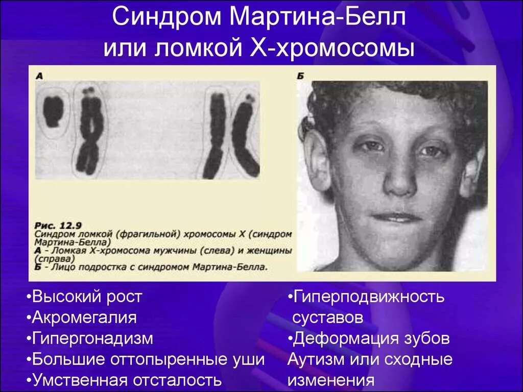 Синдром мессии. Синдром кошачьего крика кариограмма. Синдром мессии. Ассоциация charge синдром. Синдромы поражения среднего мозга.