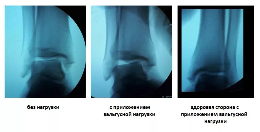 Частичный разрыв голеностопного сустава. Дисторсия голеностопного сустава. Растяжение синдесмоза голеностопного сустава. Дисторсия связок голеностопного сустава. Дисторсия капсульно-связочного аппарата.