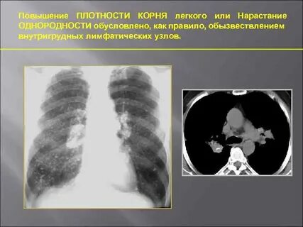 Увеличение легких