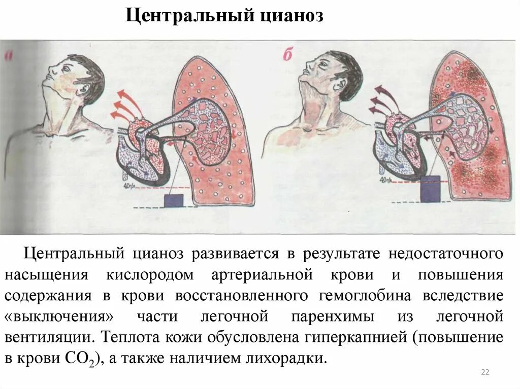 Центральный цианоз. Механизм развития центрального цианоза. Центральный и периферический цианоз. Механизм возникновения цианоза.