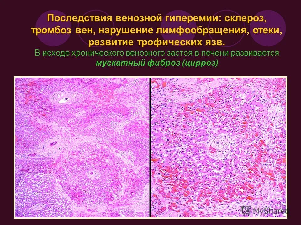 Печень при хроническом венозном застое. Хроническая венозная гиперемия. Венозная гиперемия печени. Венозная гиперемия (полнокровие). Последствия венозной гиперемии.