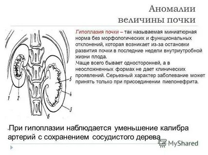 Почки уменьшить
