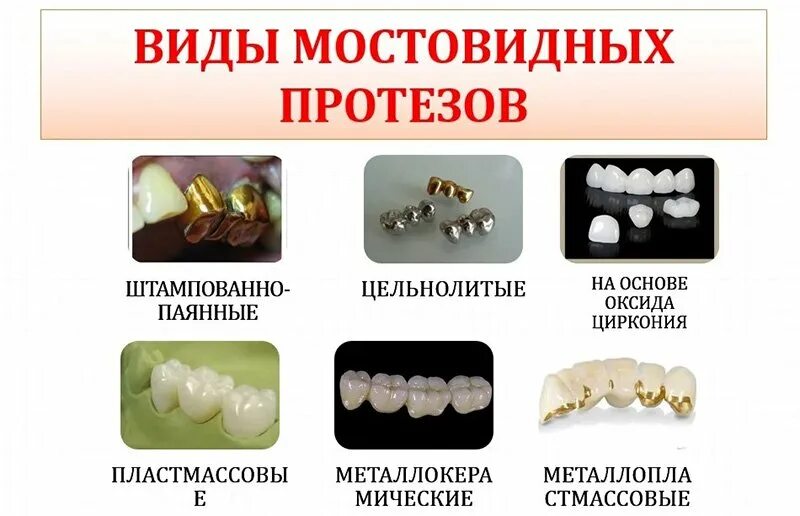 Коронки из каких материалов бывают. Классификация мостовидных протезов. Конструкционные элементы мостовидных протезов. Классификация мостовидных протезов по методу изготовления. Несъемные составные мостовидные протезы.