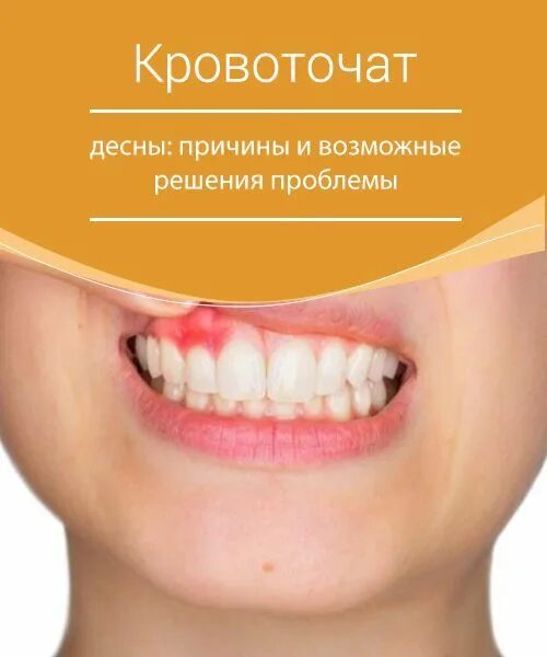 Кровоточат десны каких витаминов не хватает. Цинга развивается при недостатке витамина. Кровоточат десны каких витаминов не хватает. Аскорбиновая кислота в организме. Из чего состоят витамины.