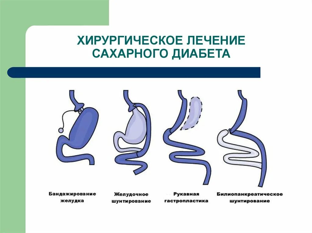 Операция сахарного диабета 2 типа. Методика хирургического лечения сахарного диабета. Бариатрическая хирургия при сахарном диабете. Хирургическое лечение сахарного диабета 2 типа. Делают ли операции при сахарном диабете