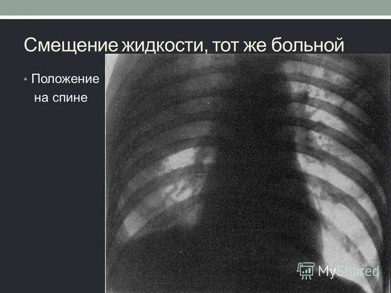 Прогрессирующий туберкулез легких. Прогрессирующий туберкулез легких