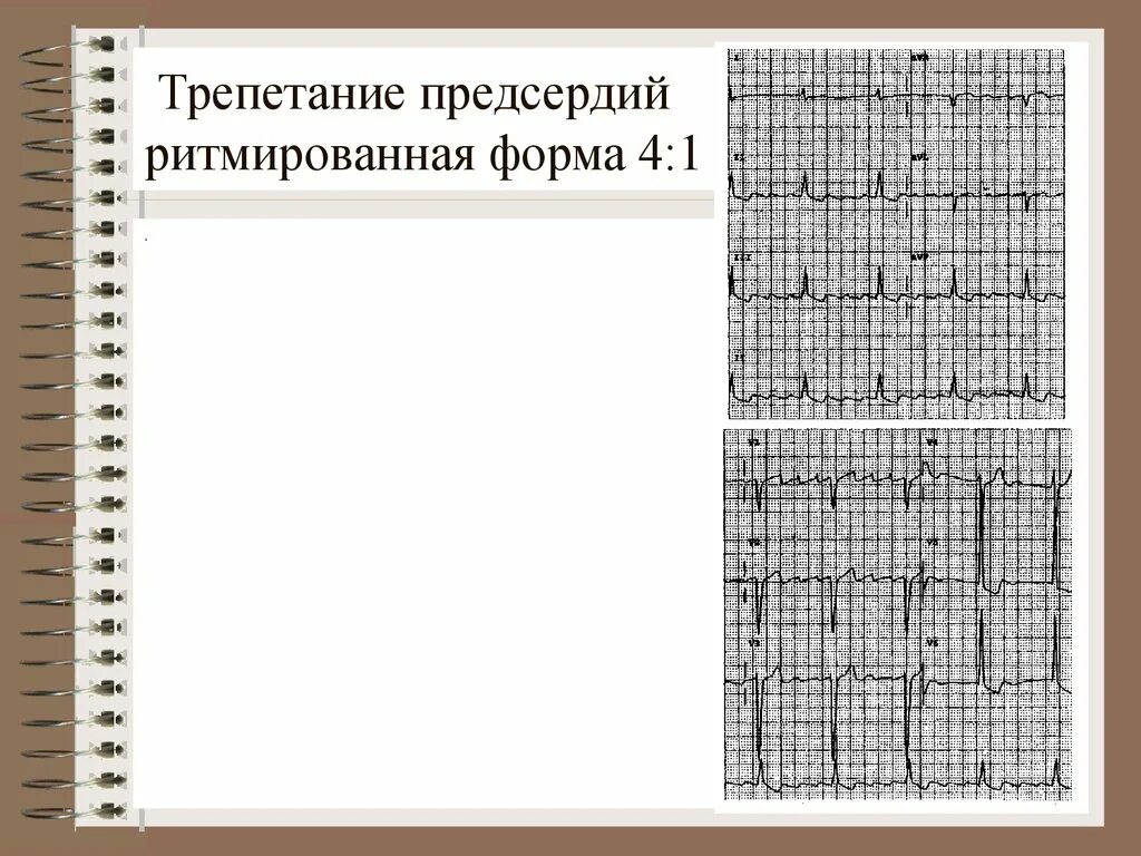 Правильная форма трепетания предсердий 2 1. Трепетание предсердий ритмированная форма 2 1. Трепетание предсердий 4 к 1. Трепетание предсердий 2 к 1 на ЭКГ. Формы трепетания предсердий