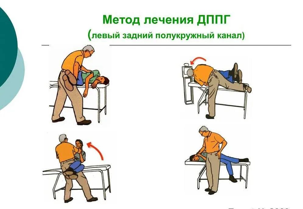 Дппг симптомы. Доброкачественное пароксизмальное позиционное головокружение. дппг доброкачественное пароксизмальное позиционное головокружение. дппг заднего полукружного канала. дппг упражнения.