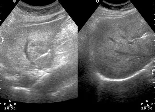 Неоднородная паренхима печени УЗИ. Паренхима диффузно неоднородная. Паренхима печени по УЗИ. Паренхима печени диффузно изменена. Структурные изменения печени
