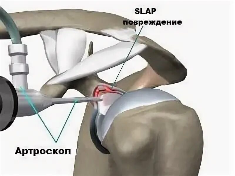 Суставной губы плечевого сустава. Артроскопия суставной губы плечевого сустава. Разрыв суставной губы плечевого сустава. Суставная губа плечевого сустава разрыв.