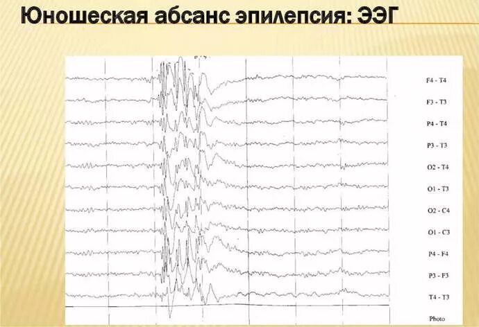 Абсансная эпилепсия на ЭЭГ. Юношеская миоклоническая эпилепсия ЭЭГ. Детская абсансная эпилепсия на ЭЭГ. ЭЭГ при юношеской миоклонической эпилепсии. Юношеская эпилепсия