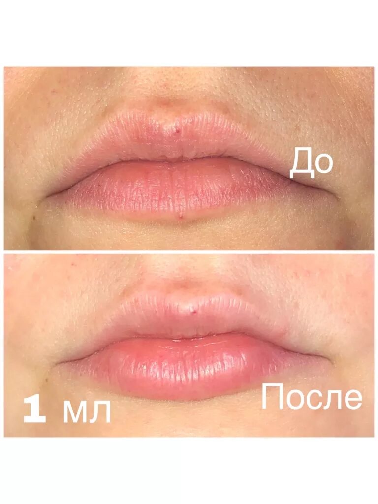 Через сколько рассасываются губы. Эффект после филлера для губ 1 мл. Филлеры в губы до и после 1мл. Увеличение губ до и после.