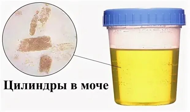 Цилиндры в моче. Хлопья в моче. Осадок в моче. Примеси в моче.