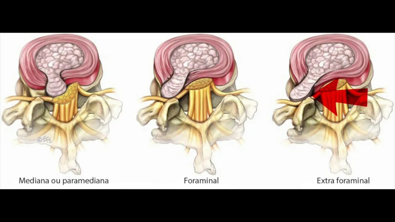Протрузия пролапс грыжа. Протрузия экструзия грыжа. Дорзальная грыжа шейного отдела. Фораминальная протрузия межпозвонкового диска. Диффузное выбухание межпозвоночного