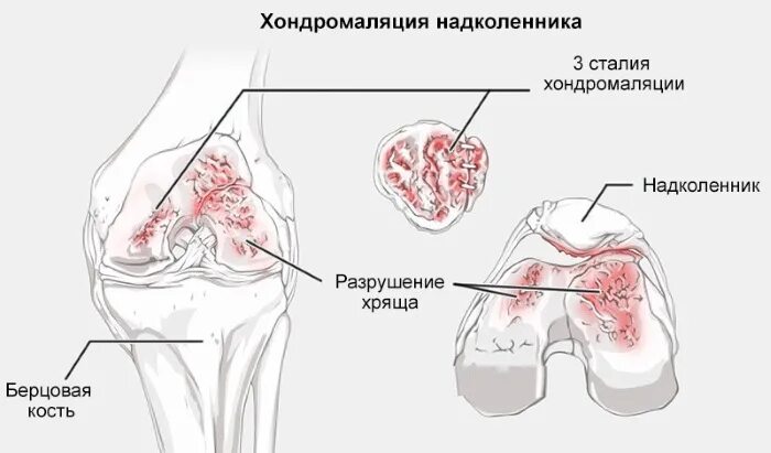 Хондромаляция медиальных мыщелков 4