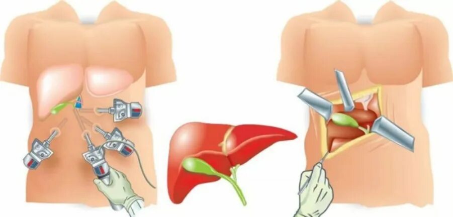 Операция по удалению желчного пузыря анализы. Холецистит и лапароскопическая холецистэктомия. ЖКБ лапароскопическая холецистэктомия. Желчекаменная болезнь лапароскопия. ЖКБ операция лапароскопия.