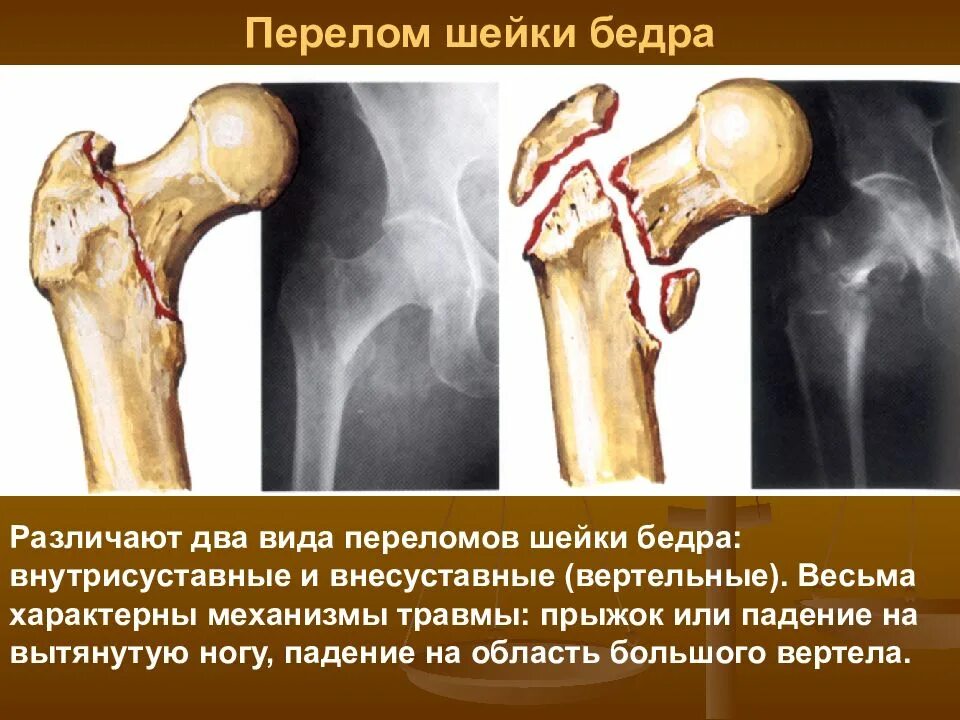 Переломы переломы кости. Внесуставные переломы шейки бедра. Перелом хирургической шейки бедра. Субтотальный перелом шейки бедра.