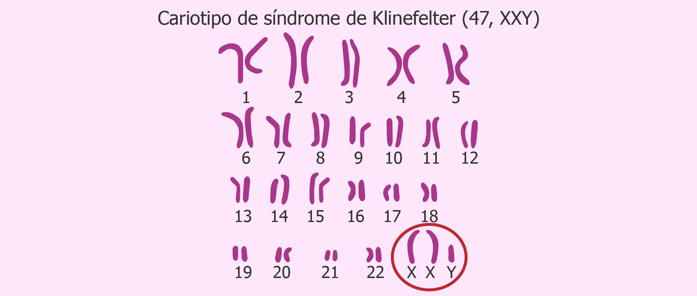 Xxy хромосома. Синдром Клайнфельтера 47 xxy. Кариотип Клайнфельтера. Синдром Клайнфельтера кариотип. Xxy синдром Клайнфельтера.