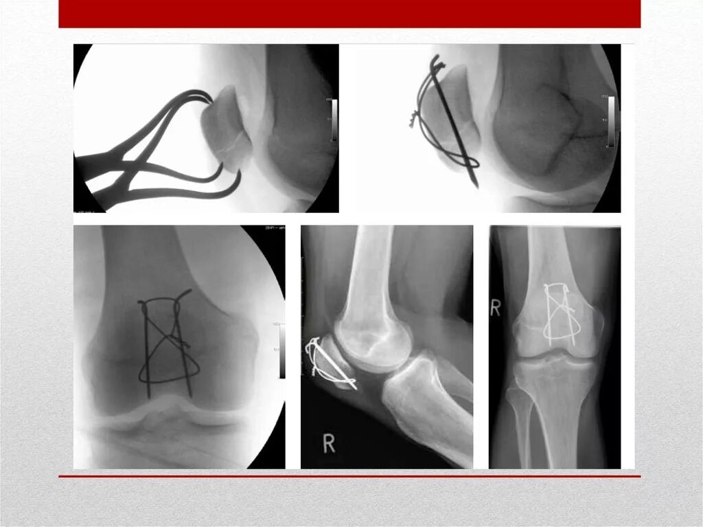 Перелом мениска рентген. Перелом надколенника остеосинтез. Оскольчатый перелом надколенника. Перелом коленного сустава мкб. Перелом надколенника операции