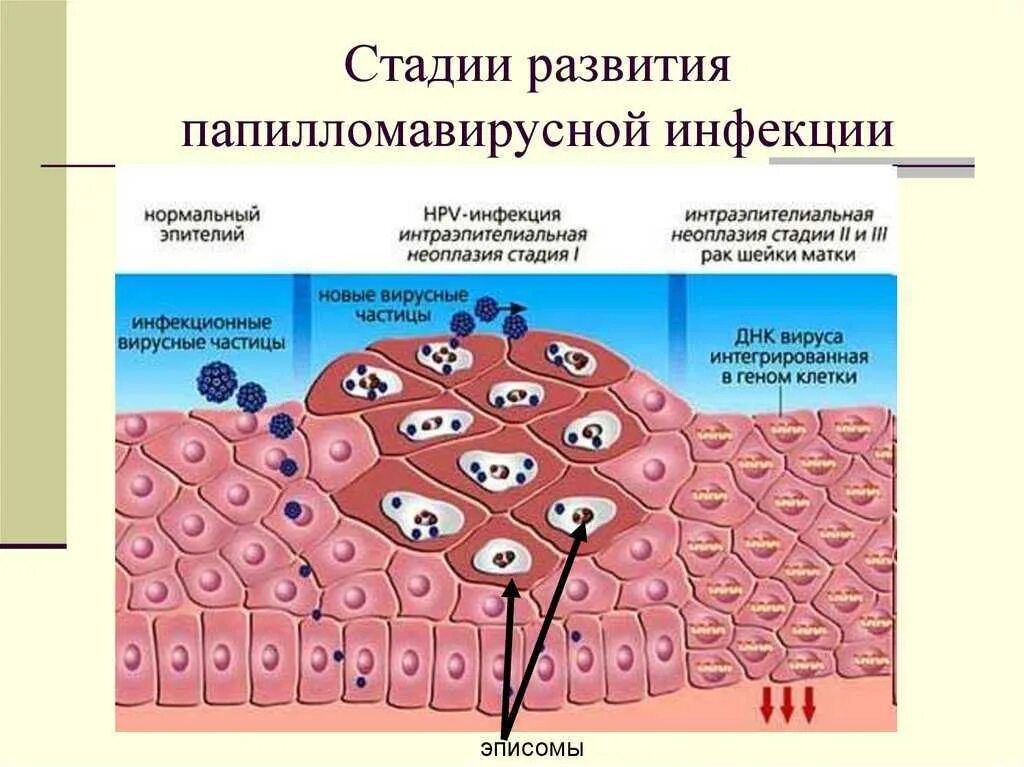 Папилломавирусная инфекция клинические проявления. Папилломавирусная инфекция (ВПЧ). Классификация и стадии развития папилломавирусной инфекции. Структура вирусной бородавки.