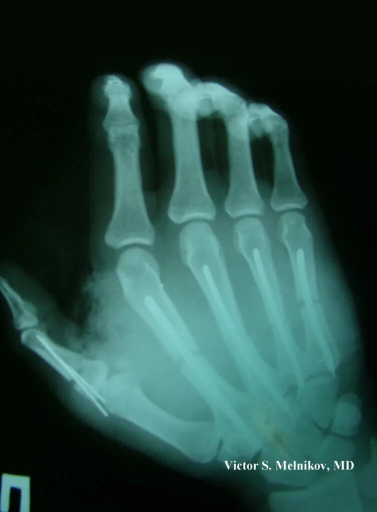Перелом дистальной фаланги кисти. Краевой перелом основной фаланги 5 пальца кисти. Перелом пятого пальца. Закрытый субкапитальный перелом 1 пястной кости. Перелом пястной кости 4 пальца.