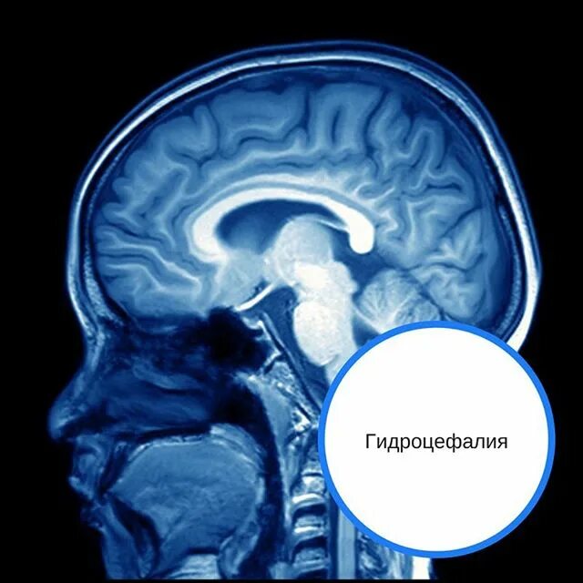 Как лечить гидроцефалию мозга. Арахноидальная гидроцефалия. Наружная гидроцефалия головного мозга. Обструктивная гидроцефалия. Гидроцефалия мозжечка.