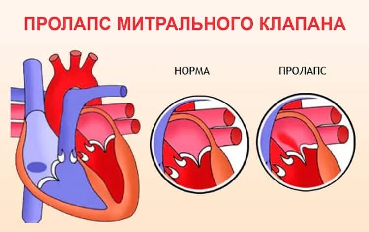 Пролапс что это такое