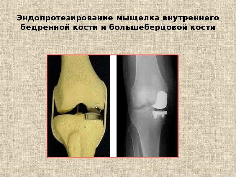 Повреждение мыщелка. Перелом наружной мыщелка бедренной кости. Перелом внутреннего мыщелка большеберцовой кости. Импрессионный перелом мыщелка бедренной кости кости. Перелом мыщелка бедренной кости.