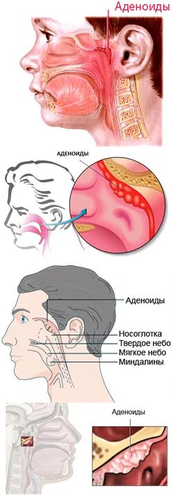 Аденоидный вегетация 3. Анатомия носоглотки аденоиды.