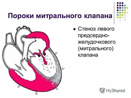 Клапанные пороки рекомендации
