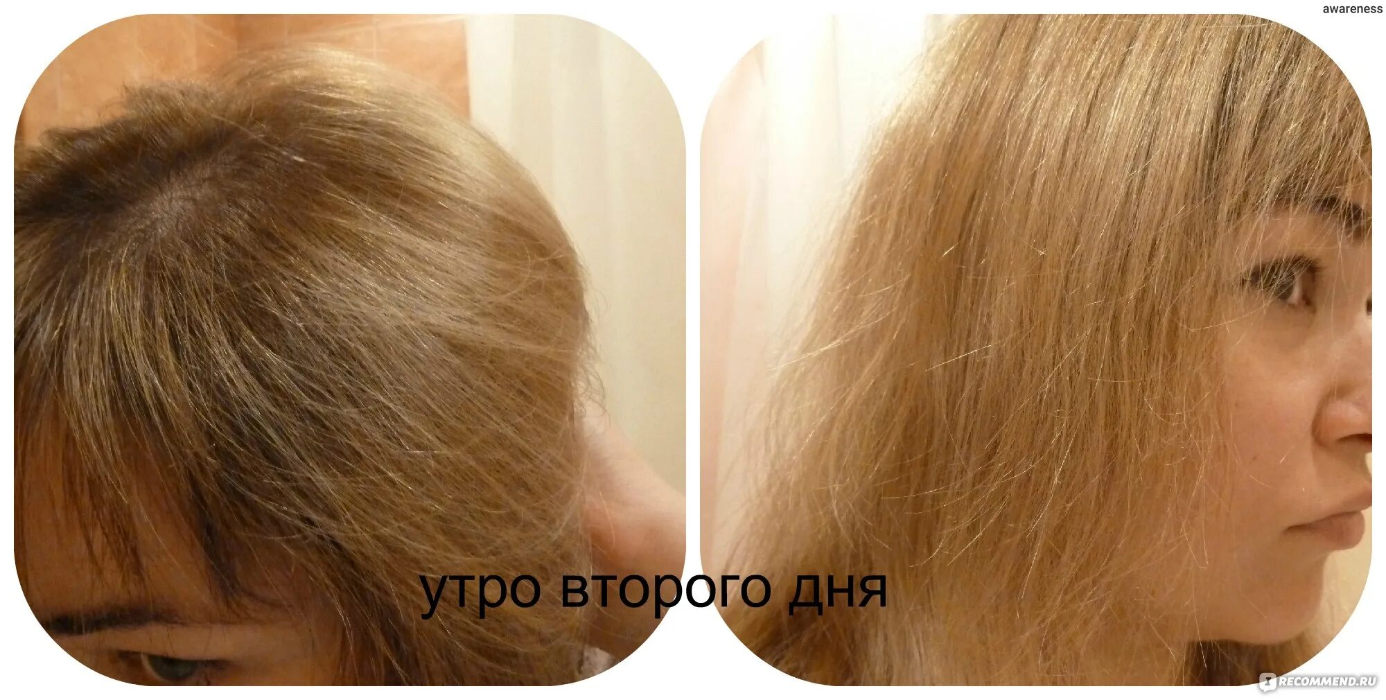 Волосы быстро белеют а дети. Седые волосы у ребенка. Андрогенная алопеция миноксидил. Как убрать седину навсегда. Волосы быстро белеют а дети.